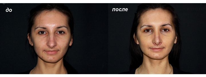 до и после ринопластики опущенного кончика носа