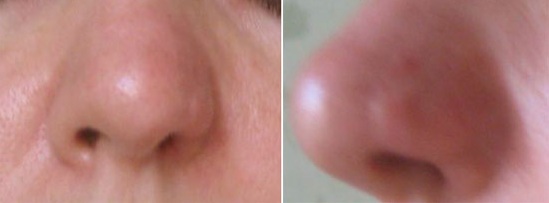 асимметрия носа