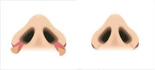 2 тип ринопластики уменьшения ноздрей