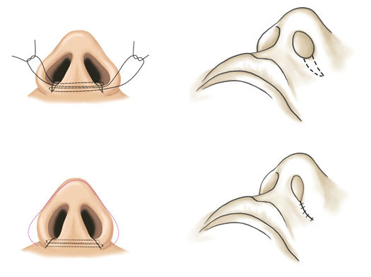 3 тип ринопластики ноздрей
