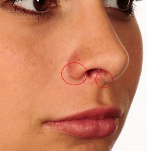 шрамы после ринопластики ноздрей