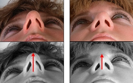 исправление длинного носа