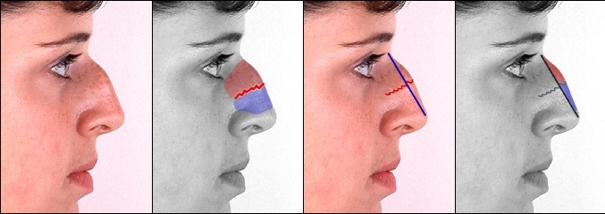 Причины образования горбинки на носу и способы ее устранения