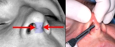 способы доступа для операции по удалению горбинки носа